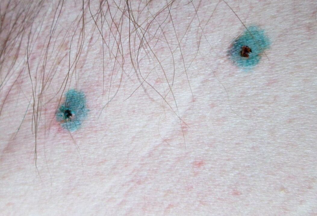 Marques sur la peau après élimination du papillome au laser. 